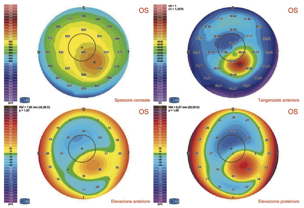 Centro Cura Cheratocono Milano E Torino Keratoconus Center