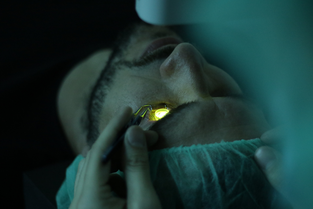 keratoconus