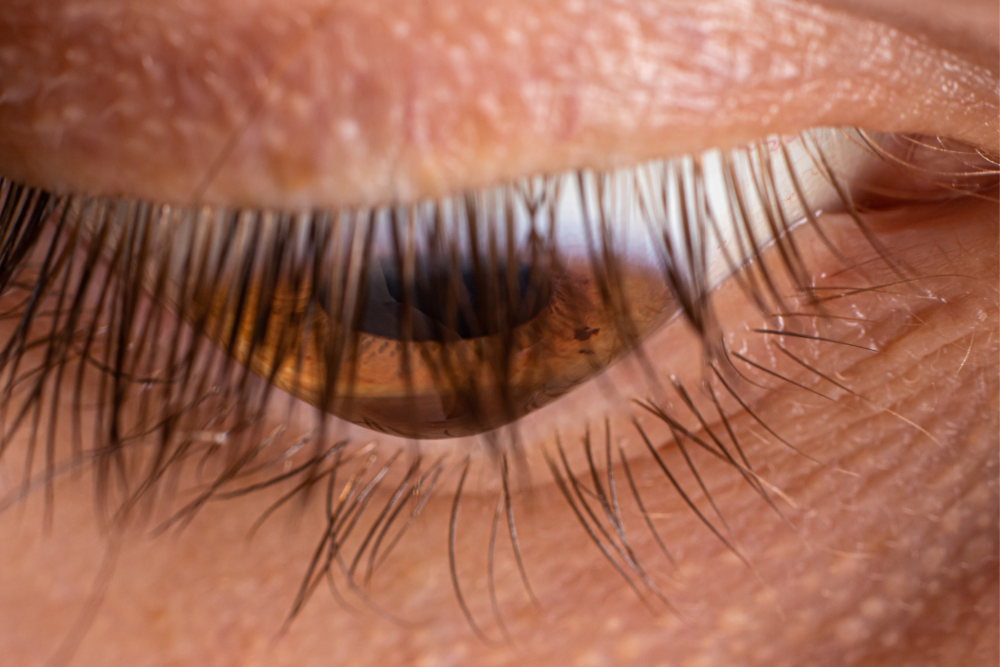 corneal transplants