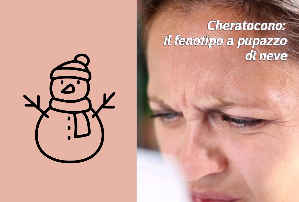 cheratocono a pupazzo di neve